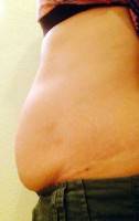 Good candidate for tummy tuck photo