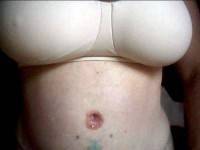 Belly button post tummy tuck operation