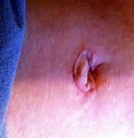 Belly buttons after tummy tuck surgery
