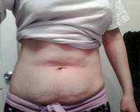 Benefits of tummy tuck before