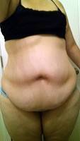Liposuction and tummy tuck photo before