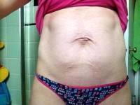 Liposuction and tummy tuck surgery