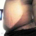 Scars from a tummy tuck photo