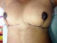 The breast augmentation tummy tuck