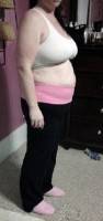 Tummy tuck for overweight picture