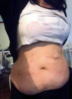 Tummy tuck lose weight before photo