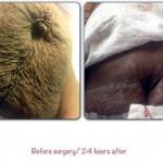 Full tummy tuck before and after photos of belly button