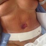 Full tummy tuck pictures and images