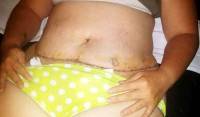 Full tummy tuck surgery pictures