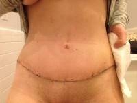 Liposuction of the mons pubis and abdominoplasty