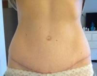 Liposuction of the mons pubis with tumm ytuck