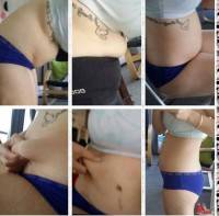 Liposuction or tummy tuck sugery after pregnancy