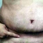 Pics of tummy tuck abdominoplasty scars