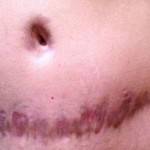 Pics of tummy tuck scar