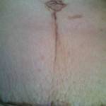 Pics of tummy tuck scars BB scar