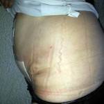 Pics of tummy tuck scars Mini