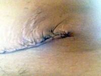 Pics of tummy tuck scars after surgery