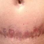 Pics of tummy tuck scars bleeding