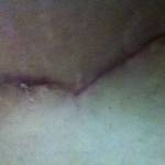 Pics of tummy tuck scars full