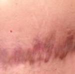 Pics of tummy tuck scars low scar