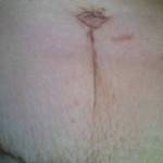 The pics of tummy tuck scars operation