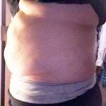 The tummy tuck before
