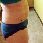 Tummy tuck after weight loss before and after pictures gallery