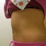 Tummy tuck after weight loss before and after pictures stretch marks