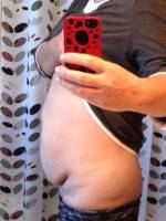 Tummy tuck after weight loss cost photo