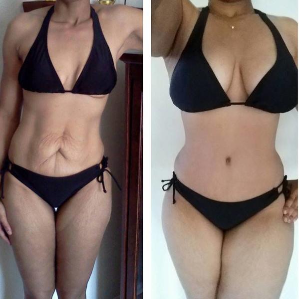 BREAST LIFT BEFORE AND AFTER