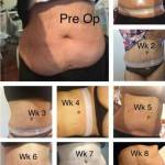 Tummy tuck before and after pics and pictures
