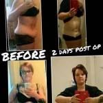 Tummy tuck before and after pics board surgeons