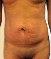 Tummy tuck just skin removal on belly