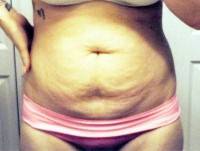 Tummy tuck operations before