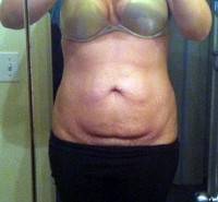 Tummy tuck scars photos image before