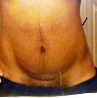 Tummy tuck stretch mark photo