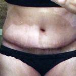 How long does swelling last after a tummy tuck (15)
