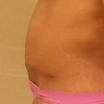 How long does swelling last after a tummy tuck (16)