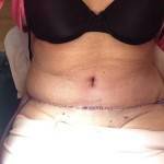 How long does swelling last after a tummy tuck (18)