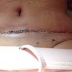 How long does swelling last after a tummy tuck (19)