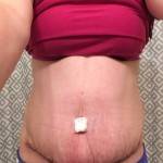 How long does swelling last after a tummy tuck (20)