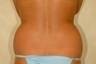 How long does swelling last after a tummy tuck photo