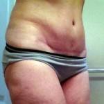 Pictures and images of tummy tuck