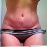 Pictures images of tummy tuck