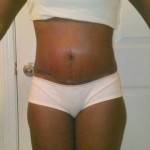 Pictures of mini tummy tuck