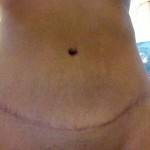 Pictures of scar of tummy tuck