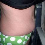 Pictures of tummy tuck (1)