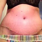 Pictures of tummy tuck (10)