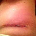 Pictures of tummy tuck (13)