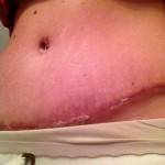 Pictures of tummy tuck (14)
